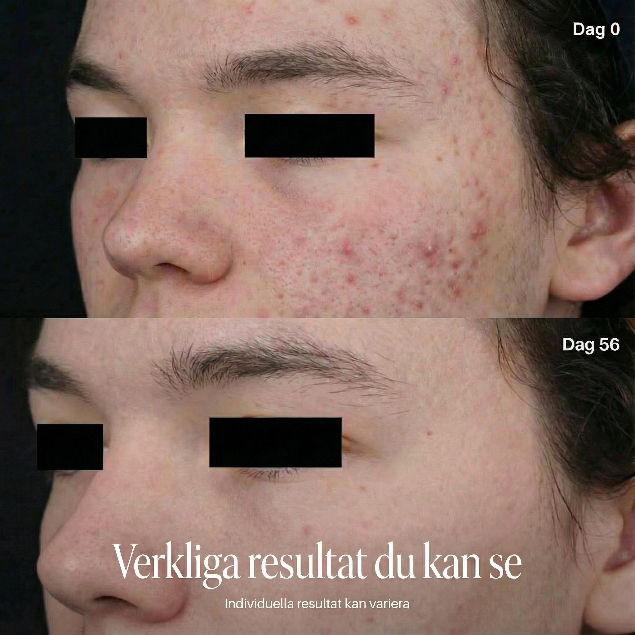 BamGlow LED Therapy Face Mask